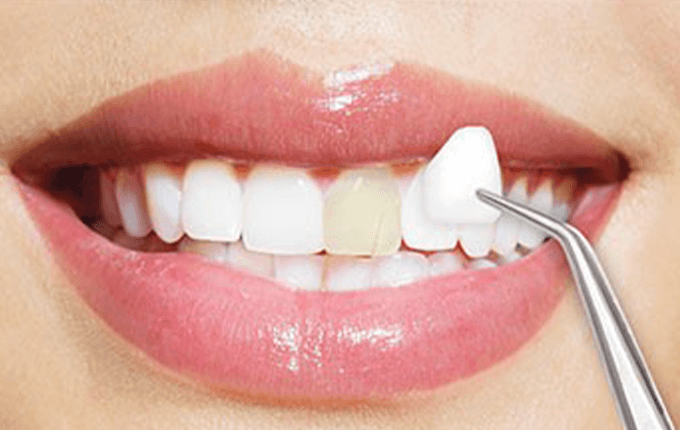 مزایای لمینت دندان 
