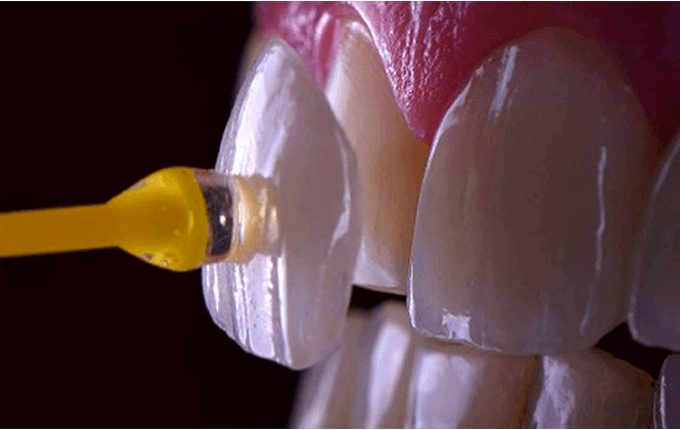 آیا لمینت به دندان های طبیعی آسیب می رساند؟