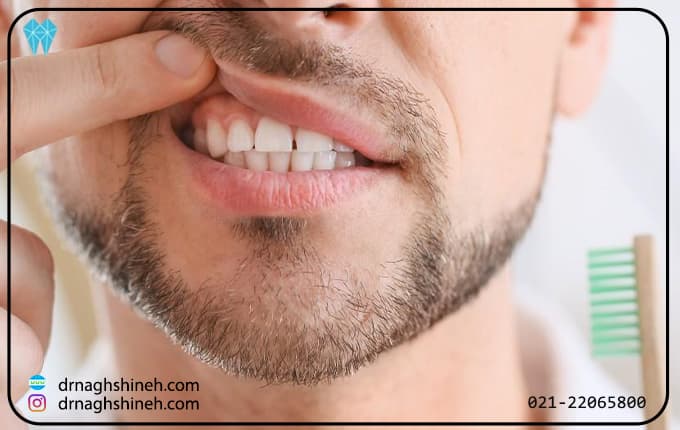 بهداشت دهان و دندان بعد از جراحی لثه باید چگونه باشد؟