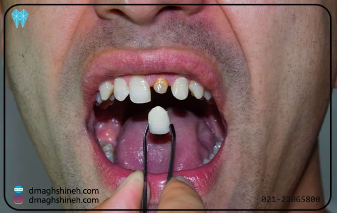 درمان جای خالی دندان