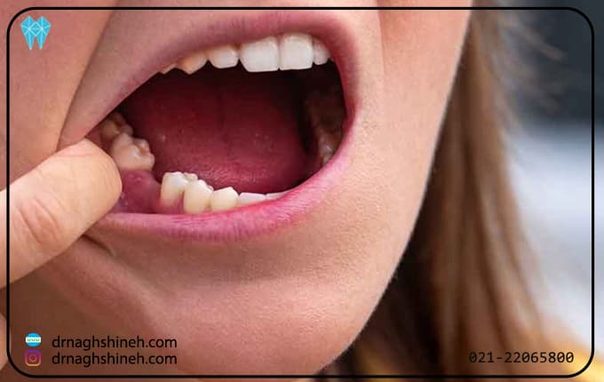 تاثیر جای خالی دندان بر سلامت دهان و دندان