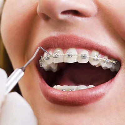 سفید کردن دندان بعد از ارتودنسی