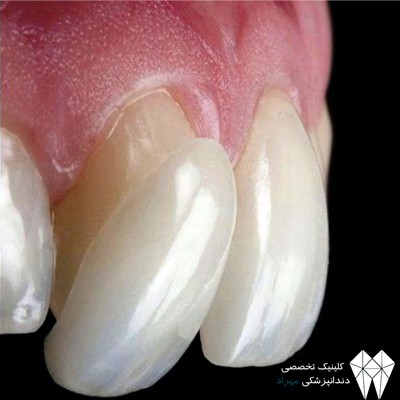 لمینیت دندان در تهران