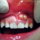 عفونت دندان و لثه