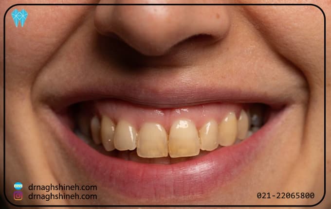 علت زرد شدن دندان چیست و چگونه آن را از بین ببریم؟ 