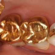 ترمیم دندان با طلا