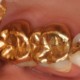 ترمیم دندان با طلا