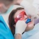 فواید فلورایدتراپی دندانپزشکی برای کودکان