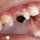 مراحل مختلف پوسیدگی دندان