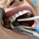 جراحی وکشیدن دندان