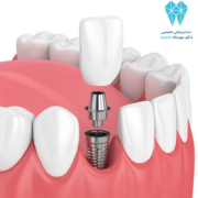 راههای جایگزینی دندان