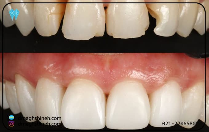 کامپوزیت دندان مناسب چه کسانی است؟ 