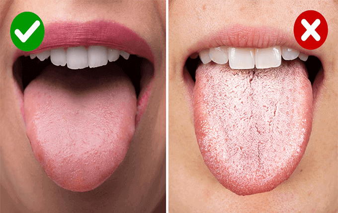 علت زخم روی زبان و دهان چیست؟ 