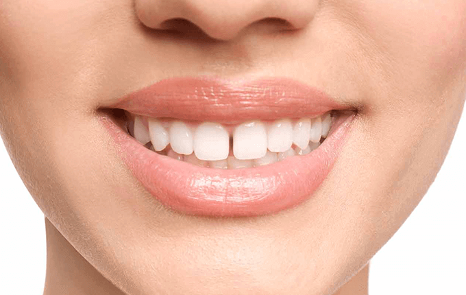 روش اصلاح فاصله بین دندان‌