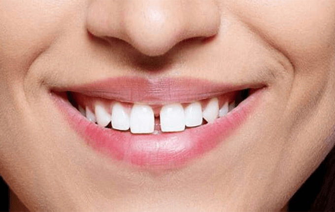 روش‌های اصلاح فاصله دندانی (دیاستما)