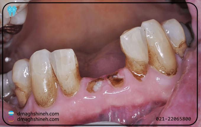 علائم نشان دهنده وجود ریشه دندان باقی مانده در لثه