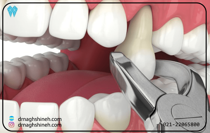 راه های درمانی دندانپزشکی برای ریشه دندان باقی مانده در لثه