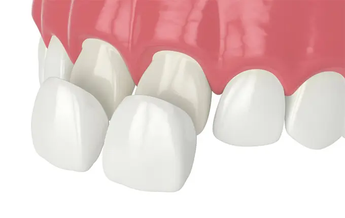 طول عمر روکش دندان چقدر است؟